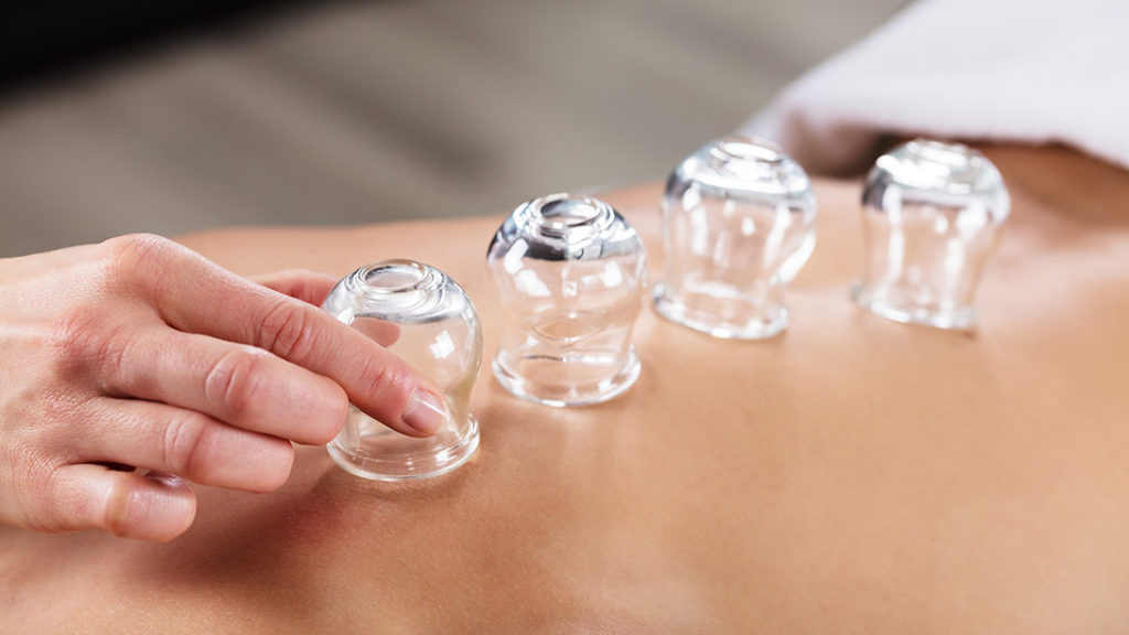 Cupping - Add it to Your Weight Loss Program for Better Results